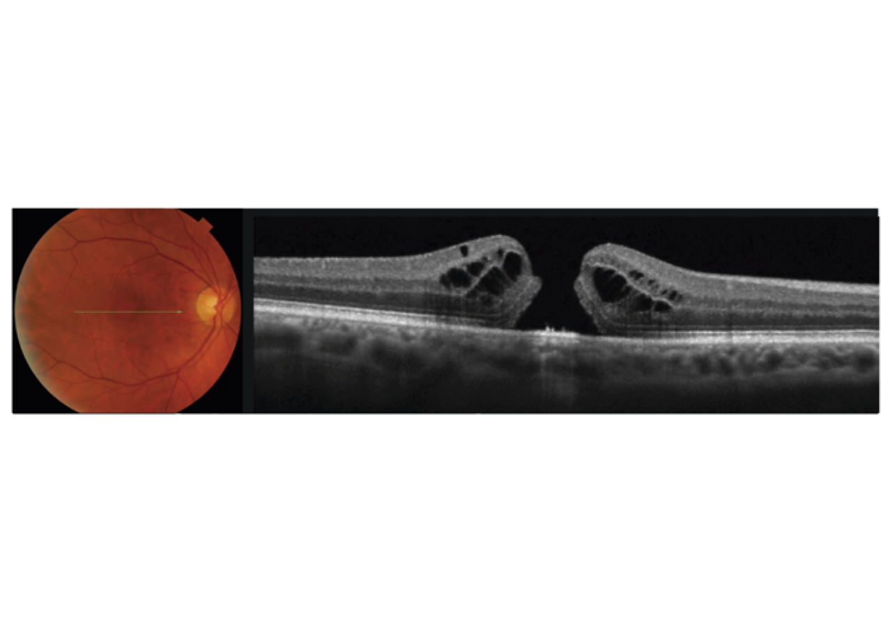 Sample OCT image with fundus photo of a macular hole