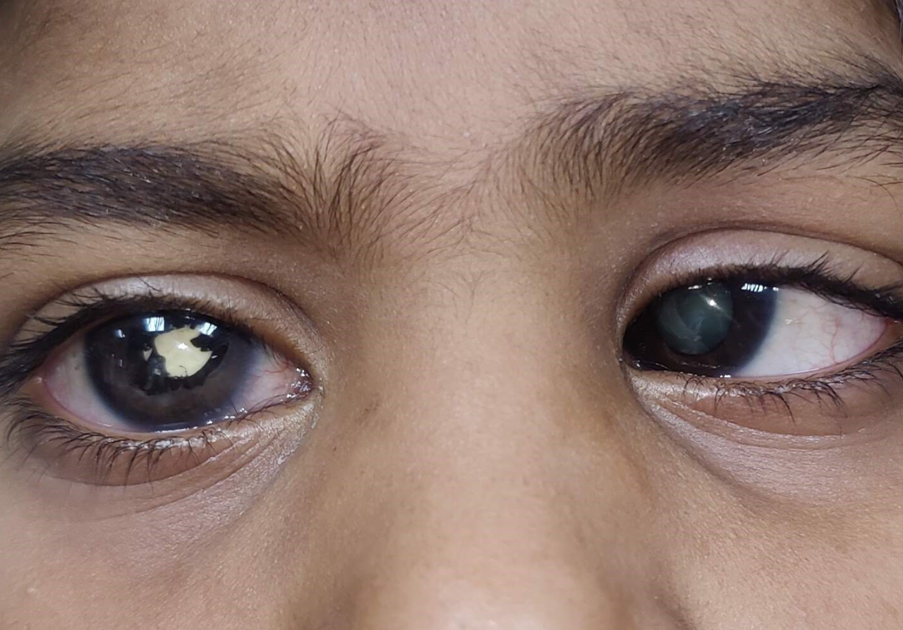 Both eyes cataract with left eye esotropia (squint)