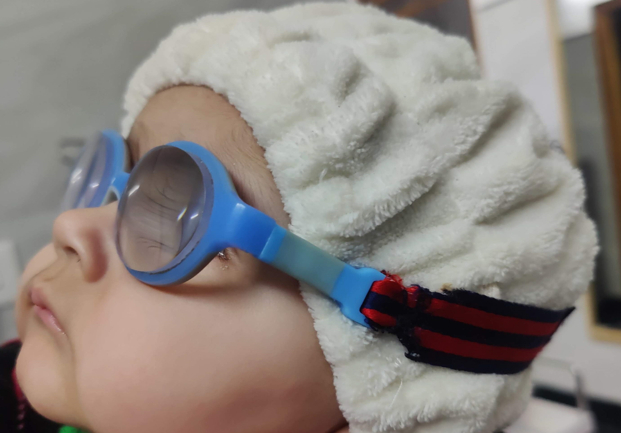 An infant (young child) with high power glasses (hyperopia)