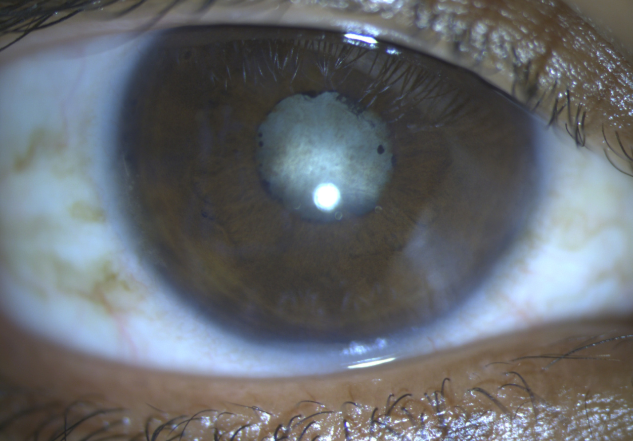 Right eye with uveitic cataract