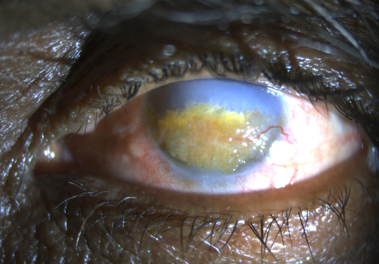 Left eye with lipid keratopathy on cornea