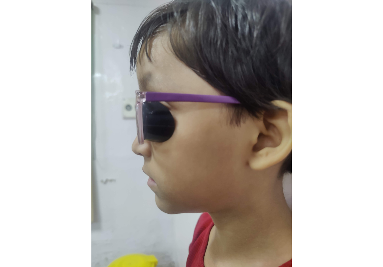 Occlusion therapy in amblyopia
