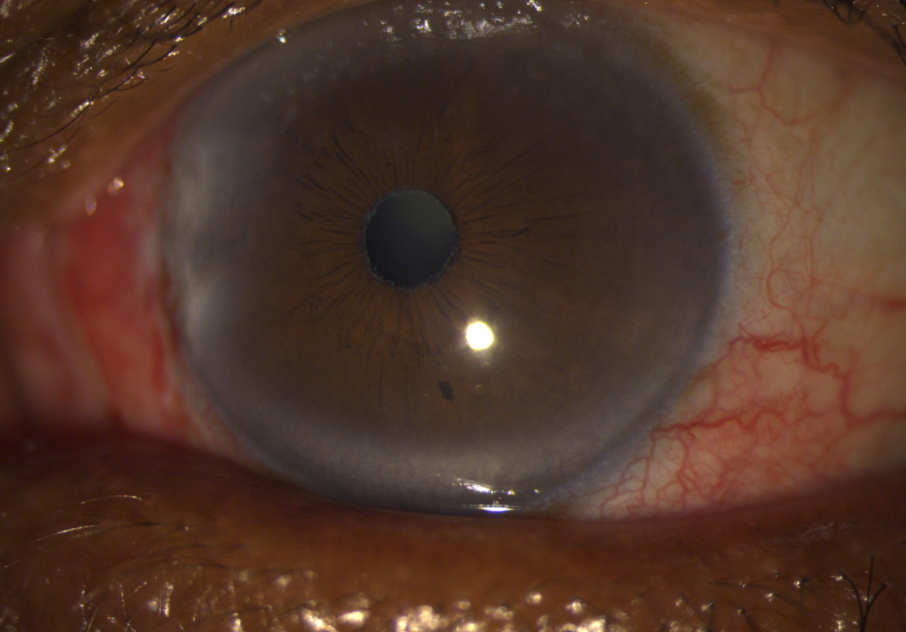 Left eye with dense arcus and PEX with cataract