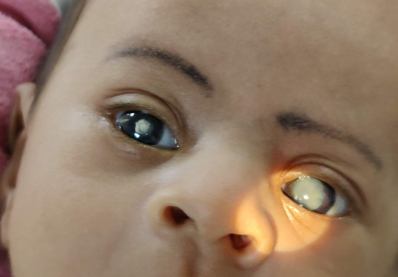 Left eye pediatric cataract