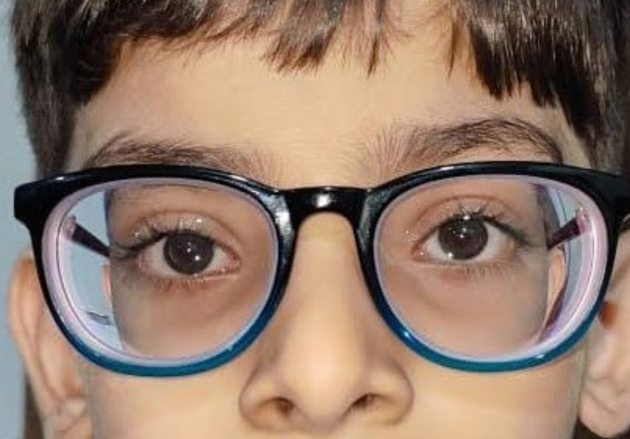 High power glasses at young age (High myopia)