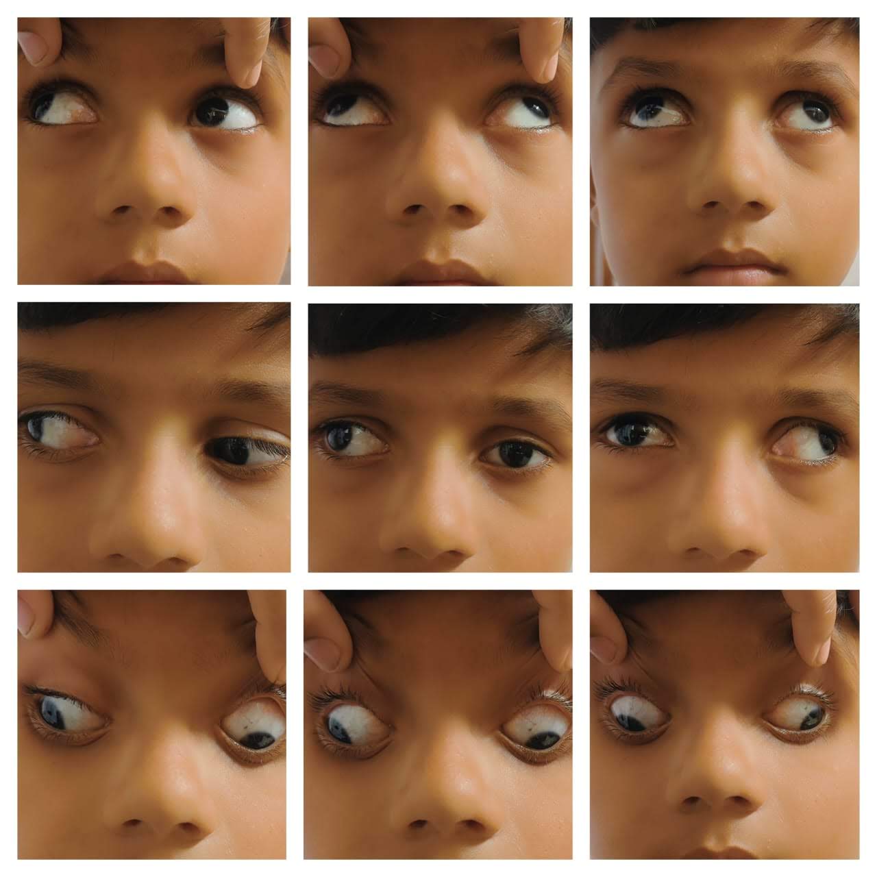 9 gaze clinical photo of exotropia (squint)